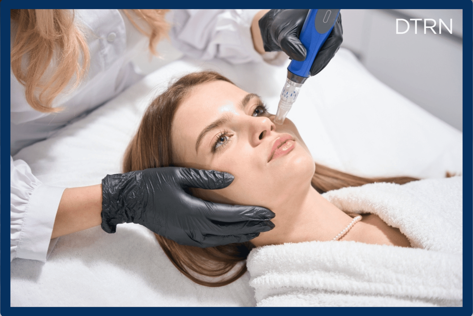 Microneedling for acne scars and open pores