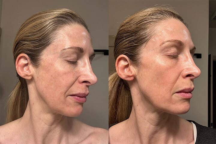 Pigmentation and melasma treatment with chemical peel in Lahore